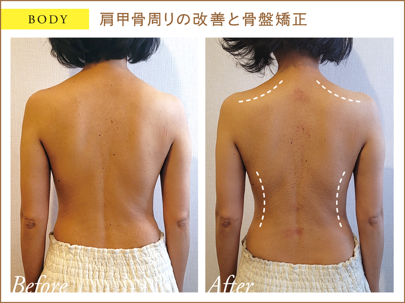 肩甲骨周りの改善と骨盤矯正 施術前後の写真
